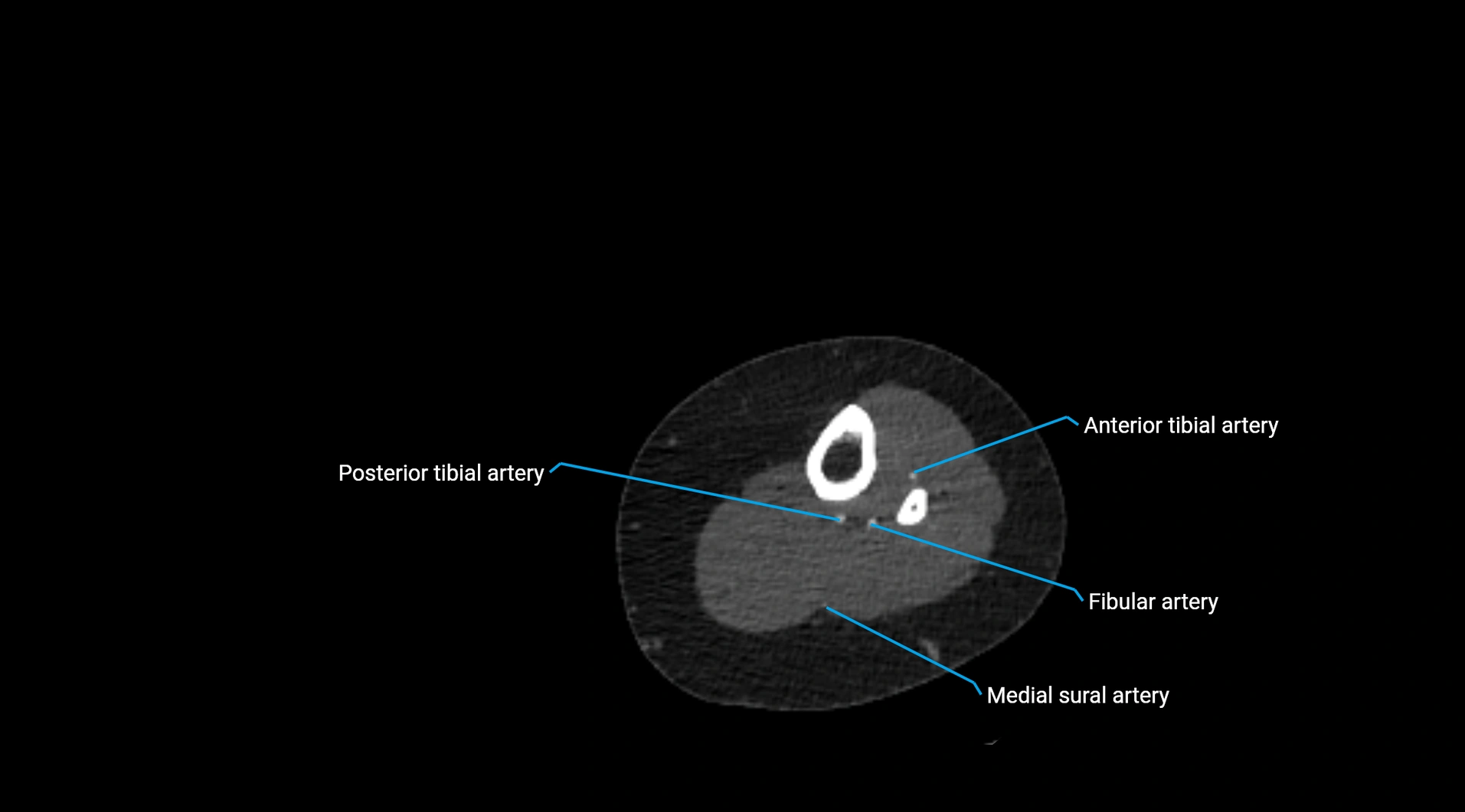 CTA lower limb cross sectional anatomy labelled image _207.webp